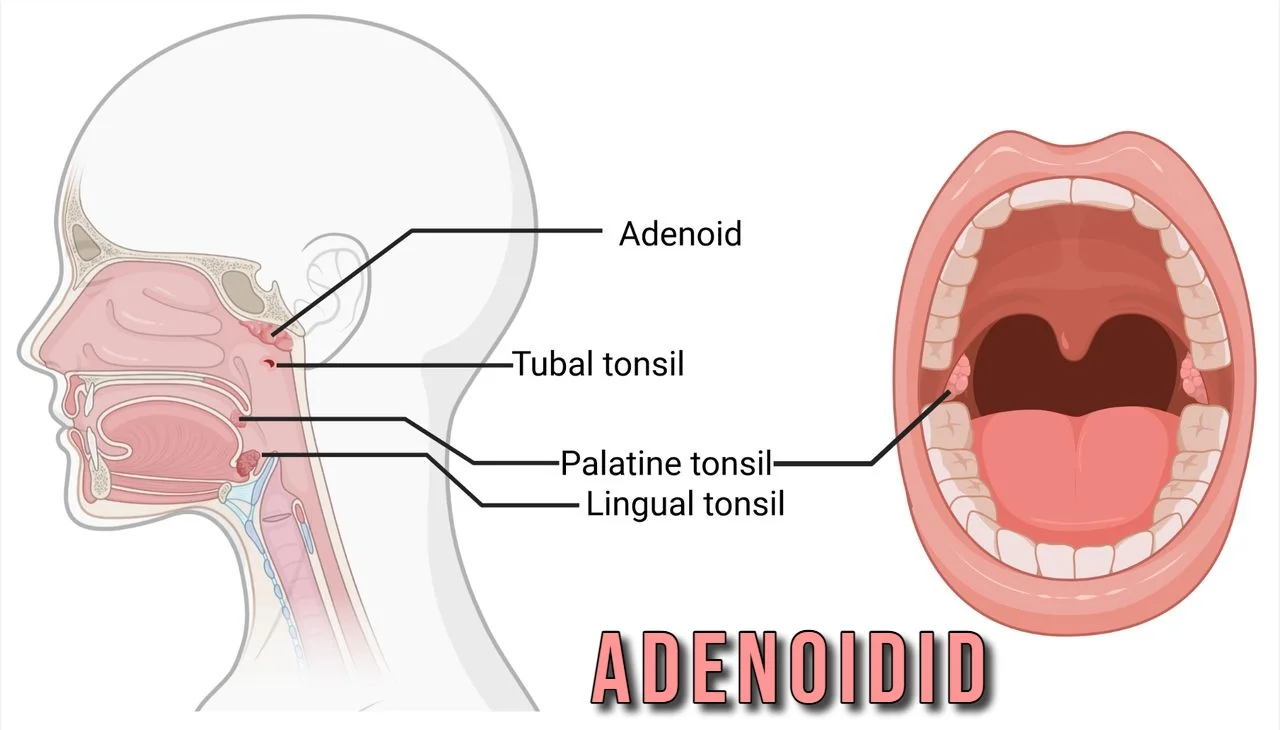 Adenoidid: Symptoms, Causes, and Treatments